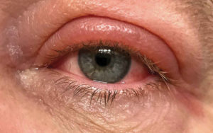 Value your eyes ocular health image